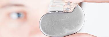 Häufige gründe für einen herzschrittmacher. Echte Und Vermeintliche Indikationen Fur Herzschrittmacher Und Defibrillatoren Medical Tribune
