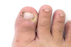 We did not find results for: Ingrown Toenail Foot Specialist Toronto Feet First Clinic