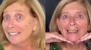 Smile Makeover in Tijuana Mexico at DrAW Dental: Watch This Life-Changing  Transformation Patient Testimonial