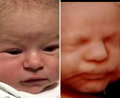 Check spelling or type a new query. Before And After 3d Ultrasound Images