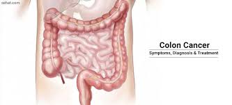Symptoms of colon cancer include changes in bowel habits and unexplained abdominal pain. Colorectal Colon Cancer Symptoms Treatment Diagnosis