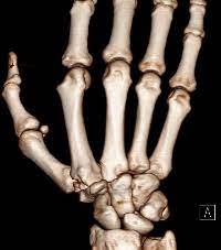 Agaplesion Dkh Mittelhandbruch