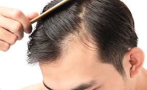 When it comes to hair loss, the theory is that platelets, injected deep into the scalp to reach the bottom of the hair follicle, may stimulate a specialized population of cells named dermal papilla cells, which play a critical role in hair growth. What Is Prp Injection For Hair Loss Vargas Face And Skin Center