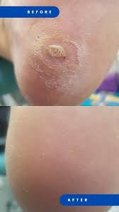 Image result for verruca