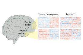 As little is known about the etiopathophysiology of asd and early diagnosis is relatively subjective, we aim to employ a targeted, fully quantitative metabolomics. Brains Of People With Autism Spectrum Disorder Share Similar Molecular Abnormalities Ucla