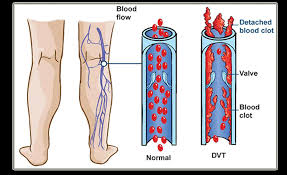 Veins carry blood from the body back into the heart. Deep Vein Thrombosis Trombosis Vena Dalam Medicaboo Blog