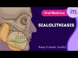 Image result for Sialolithiasis