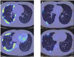 Dog 6 had dyspnea and pericardial and pleural effusions. Fdg Pet Ct Scan A Extensive Nodular Thickening Of The Right Pleura At Download Scientific Diagram