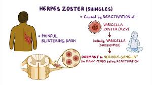 Image result for herpes zoster