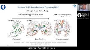 A population based study of multiple sclerosis in twins: Emsp Definicion Epidemiologia Factores Predictivos Del Paso De Emrr A Emsp Y Evolucion Esclerosis Multiple En Linea