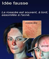 Vous voulez en finir avec ce problème qui vous gâche la vie ? Dermato Info Couperose Et Rosacee