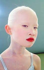Pin By Yvette Borromeo Guiuan On No Words Albinism Face Interesting Faces