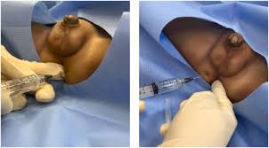 Image result for Pudendal Block