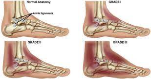 The most basic system is based on how many ligaments are injured. Pt Guide To Ankle Sprain Physical Therapy Injury Specialities