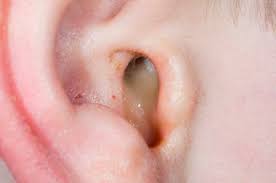 Previous tennitus louder after ear infection. Nhs 111 Wales Health A Z Tinnitus