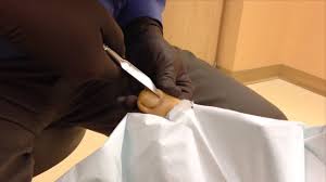 Prepare iud prior to starting procedure. Procedure Videos Dr Jeff M D