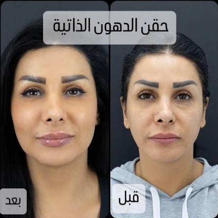 عملية حقن الدهون الذاتية (النانو فات) بتقنية الخلايا الجذعية والمجهرية  الأكثر أماناً وتعطي نضارة وحيوية للبشرة وعلاج للهالات السوداء تحت العين،  وأيضا حقنها بفروة الرأس لزيادة كثافة الشعر ومنع تساقطه مع دكتور