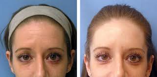 However, as with botox and dysport, as well as other injectables and dermal fillers, it can take up to two weeks (14 days) for this injectable to be fully absorbed by your body, so it does not fully kick in until then to show you results with fewer forehead lines. Dysport Botox Restor Medical Spa