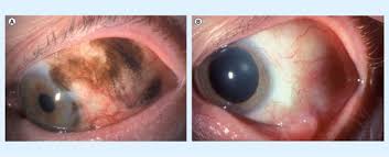 Image result for conjunctival melanoma