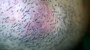 The collar of your coat, shirt, sweater, scarf, or hair band might rub at the base of your skull where the tiny, fine head hairs emerge. Keep Getting Ingrown Hair In The Same Place Popping