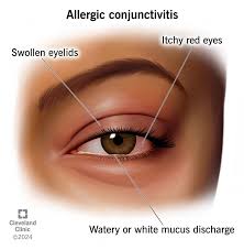 Image result for Acute Red Eye