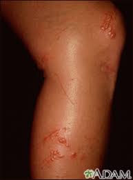 Image result for dermatitis contacta toxica