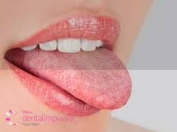 Que Es La Glositis O Inflamacion De La Lengua