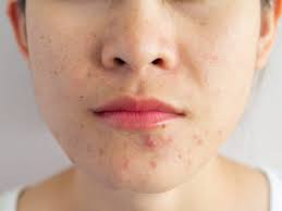 If you've used a mighty patch or another hydrocolloid patch before, this is what you can see left on the patch after you remove it. Tiktok Users Are Using Giant Gel Bandages To Shrink Their Pimples