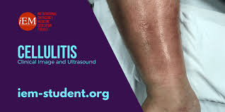 Although cellulitis can occur anywhere on your body, the most common location is the lower leg. Cellulitis Clinical Image And Ultrasound International Emergency Medicine Education Project