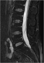 Image result for XRay Changes in Rheumatic Conditions