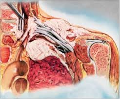 Bone pain (like pain in the back or pancoast tumors can also sometimes cause severe shoulder pain. Pancoast Tumor Physiopedia