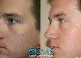 It is said that the reported laser acne scar removal cost ranges between $700 and $800 per session on the average and can be much higher depending on which facility and location you want the procedure done. Laser Acne Scar Removal Results Laser Acne Scar Removal Re Flickr