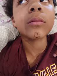 ✨ROWE CASA TESTIMONIAL✨ My child was bit by a dog while visiting with a  friend. The first two pictures show about an hour after it happened. By  that evening it had began