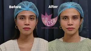 Lateral Brow Lift With Pdo Threads Foxy Eyes By Csa Youtube (( i like him but he's just meh for me)) i missed out a frame by mistake that's why it looks like this it's a pretty good mistake if i do say so myself. lateral brow lift with pdo threads foxy eyes by csa