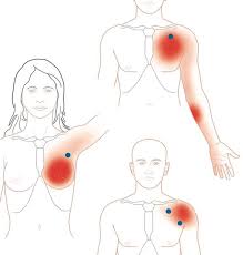 Although you can't stop the effects of aging, you can begin doing targeted exercises for women to firm and lift the chest. Trigger Point Therapy Treating Pectoralis Major Niel Asher Education