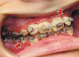 Check spelling or type a new query. How To Remove Braces From Teeth Arxiusarquitectura