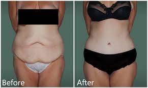 Check spelling or type a new query. Abdominoplasty After Weight Loss Manhattan Nyc Panniculectomy