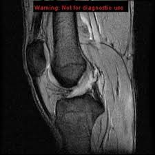 It's most commonly torn during. Anterior Cruciate Ligament Tear Radiology Reference Article Radiopaedia Org