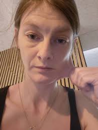 How to sue Yale for dismissing Ehlers Danlos symptoms?