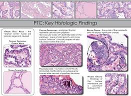 The increasing incidence of small thyroid cancers: Papillary Thyroid Carcinoma