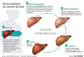 La détoxification du foie peut être faite en consommant les bons aliments. Cirrhose Quand L Alcool Detruit Le Foie