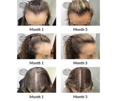 Normal hair growth occurs in a repeating cycle of growth, fall and replacement. Hair Growth Success Story So Happy With The Results After 3 Months