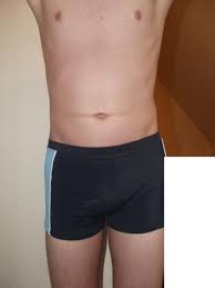 Roter Streifen Auf Bauch Sport