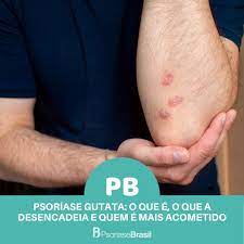 A psoríase gutata afeta preferencialmente a criança, o adolescente e o jovem adulto. Psoriase Brasil A Psoriase Gutata Geralmente E Desencadeada Por Infeccoes Bacterianas Como As De Garganta E Caracterizada Por Pequenas Feridas Em Forma De Gota No Tronco Nos Bracos Nas Pernas E