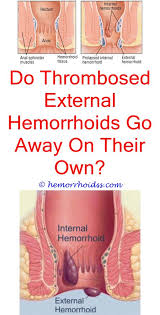 Pin On How To Treat Hemorrhoids