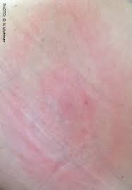 Il peut développer une borréliose de lyme ou maladie de lyme. Maladies Transmises Par Les Tiques Republique Et Canton De Neuchatel