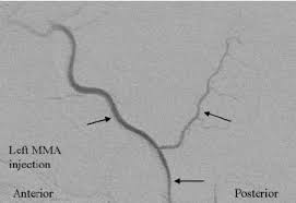 Medidural artery) is the largest of the arteries which supply the dura mater. Superselective Left Middle Meningeal Artery Mma Angiogram In Lateral Download Scientific Diagram