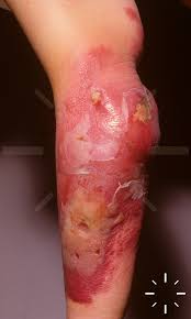 Image result for erysipel photos)