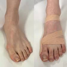 Taping For Bunions Foot Remedies Bunion Kinesiology Taping