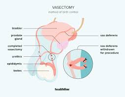 Image result for Vasectomy